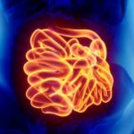 Inflamação no Intestino - Sintomas, Causas e Tratamento