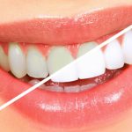 Clareamento Dental Caseiro - 6 Mais Famosos Tipos e Cuidados