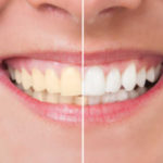 Como Clarear os Dentes com Bicarbonato