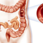 Pólipos no Intestino - O Que São, Sintomas, Causas e Tratamento