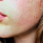 7 Remédios para Alergia na Pele Mais Usados
