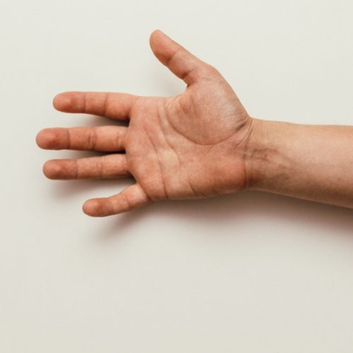 Neuropatia mãos