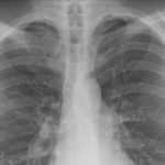 O Que é Embolia Pulmonar e Principais Causas