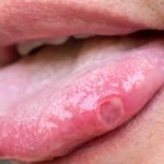 Tipos de úlceras mais comuns e como tratar