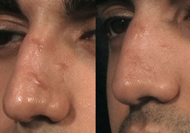 tratamento com laser para queloide no nariz
