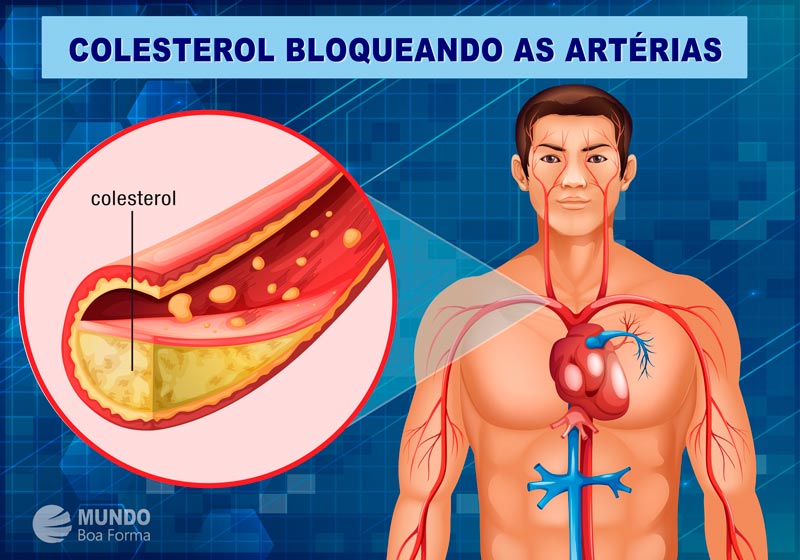 diagrama colesterol bloqueando artérias