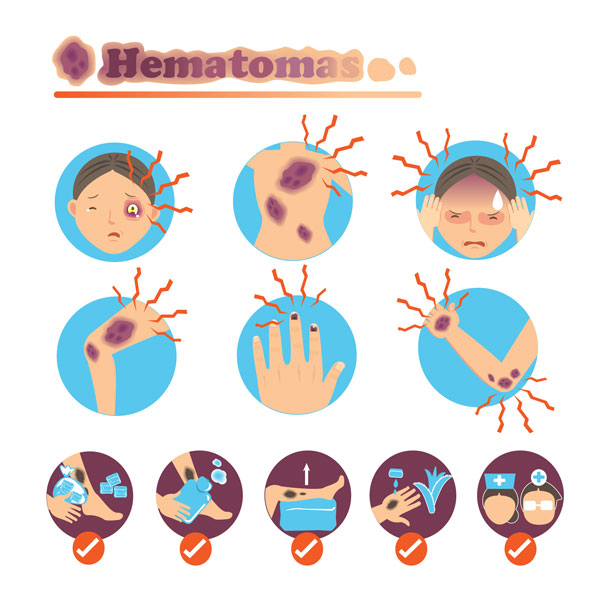 ilustração hematomas