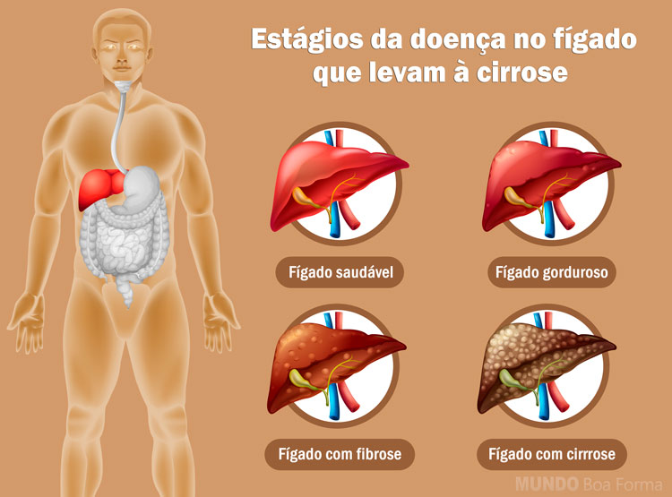 ilustração do fígado saudável até o fígado com cirrose
