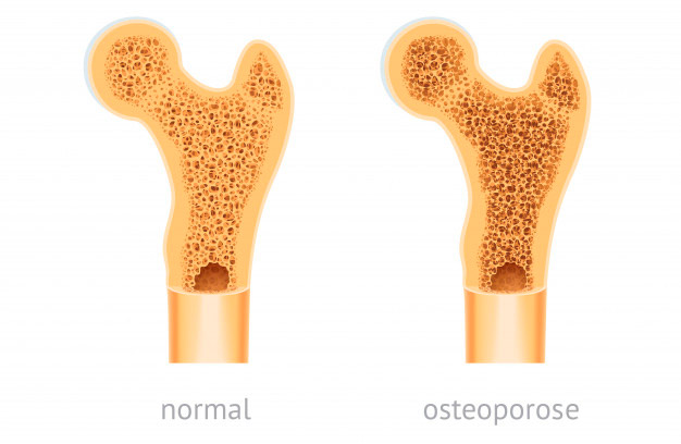 Osso normal vs osteoporose