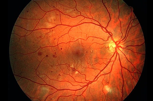 retinopatia diabética