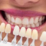 Implante dentário - Tipos, quando é indicado e como é feito