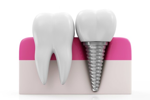 dente artificial