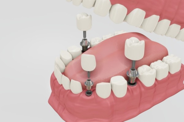 ilustração de implante dentário