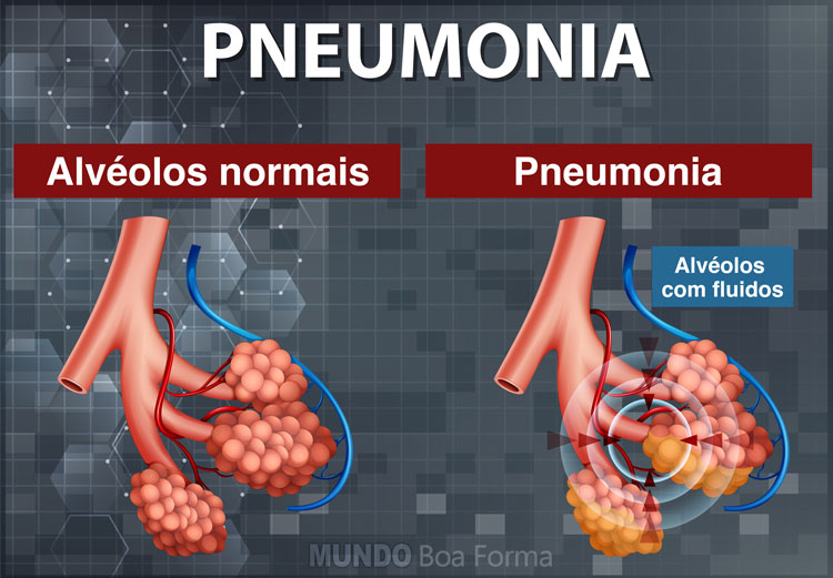 alveolos e pneumonia